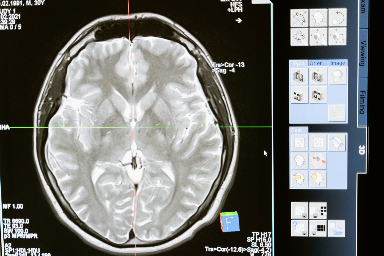 prefrontal cortex MRI scan